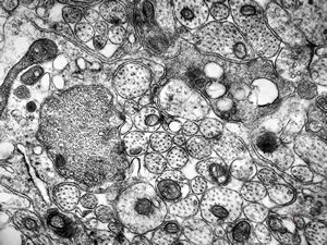 M,26y. | a periphery of a glial scar M,26y. | a periphery of a glial scar